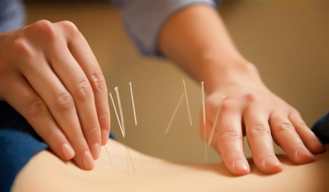 acupuncturist treating patient with needles