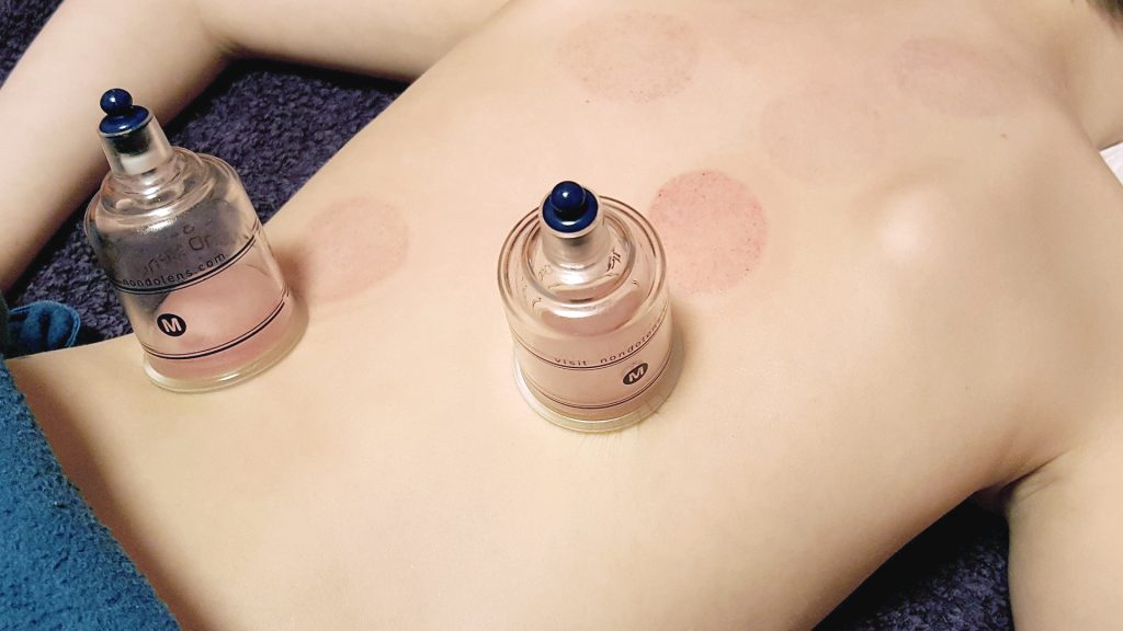 cupping treatment on patient's back