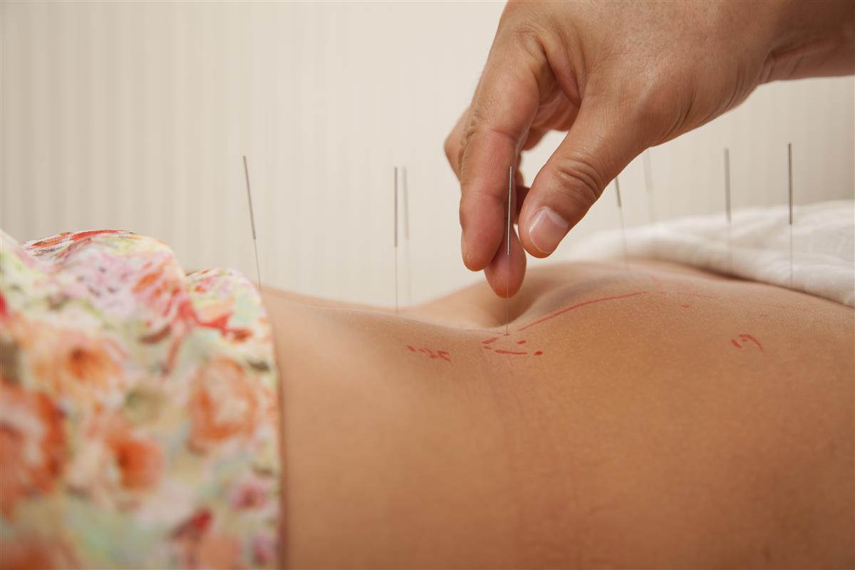acupuncture needles in patient's stomach