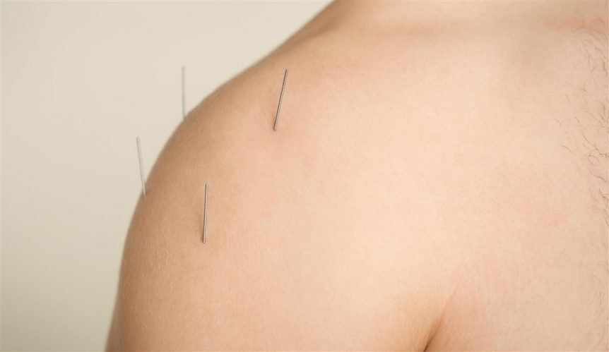 acupuncture needles on patient's shoulder